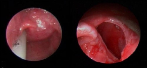 Figure 1 The saccular cyst before and after the first excision in case 1.