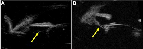 Figure 1 (A) An ultrasound biomicroscopic (UBM) image illustrating zonular stretching and thinning (Yellow arrow) with a normal crystalline lens in a 26-year-old patient with blunt trauma. (B) An ultrasound biomicroscopic (UBM) image illustrating zonular stretching (Yellow arrow) in a 55-year-old pseudophakic patient with blunt trauma.