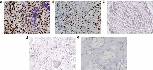 Figure 1. PROX1 expression was upregulated in OS tissues. (a) OS tissue with PROX1 high expression. (b) OS tissue with PROX1 moderately expression. (c) OS tissue with PROX1 weakly or negative expression. (d-e) The expression of PROX1 in normal bone tissue adjacent to the tumor and control OS group. OS, osteosarcoma.