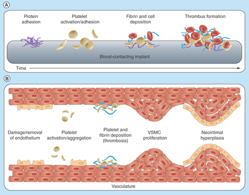Figure 7.  Vascular procedures damage the endothelial lining leading to decreased production of nitric oxide required for vascular homeostasis.This results in thrombus formation and neointimal hyperplasia with subsequent stenosis.VSMC: Vascular smooth muscle cell.Reproduced with permission from [Citation34] © The Royal Society of Chemistry (2012).