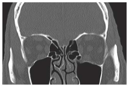 Figure 1 Preoperative coronal computerized tomography scan demonstrating a left inferior floor fracture with herniation of the inferior rectus and orbital fat contents inferiorly.