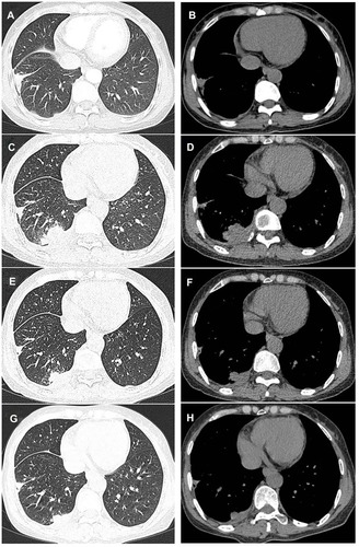 Figure 2 Case 1. Time course of CT findings in the right-inferior pulmonary lobe. (A and B) There was no obvious mass at the initial diagnosis of pulmonary tuberculosis. (C and D) A new occupying lesion in diameter of 3.4cm×2.3cm appeared after six months of chemotherapy, and its margin was irregular. (E and F) The mass was diminished to 1.5cm×1.3cm seven months after the initial diagnosis. (G and H) The mass was 0.9cm×1.1cm nine months after the initial diagnosis.