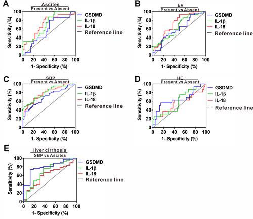 Figure 4 Differentiating power of serum GSDMD, IL-1ß and IL-18 for liver cirrhosis with various complications. (A) ROC curves of serum GSDMD, IL-1ß and IL-18 for predicting liver cirrhosis with ascites. (B) ROC curves of serum GSDMD, IL-1ß and IL-18 for predicting liver cirrhosis with EV. (C) ROC curves of serum GSDMD, IL-1ß and IL-18 for predicting liver cirrhosis with HE. (D) ROC curves of serum GSDMD, IL-1ß and IL-18 for predicting liver cirrhosis with SBP. (E) ROC curves of serum GSDMD, IL-1ß and IL-18 for predicting SBP occurrence in the setting of ascites for liver cirrhosis patient.