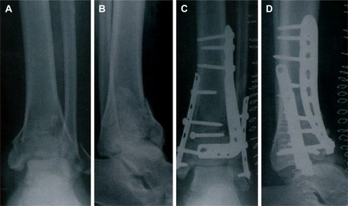 Figure 1 A male patient (63 years old) with type III pilon fracture.