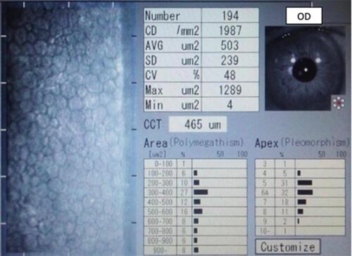 Figure 3 I It was possible to obtain a specular microscopy reading unlike the first day.