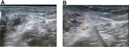 Figure 2 Ultrasound images of catheter placement (C) at the level of the right popliteal nerve (N) below the perineural sheath.