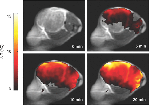 Figure 2. Spatial temperature map of magnetic resonance thermal imaging indicating temperature rise (°C) above the baseline following near infrared illumination of gold nanoshell-laden tumours (Reproduced with permission from Diagaradjane P, et al. Modulation of in Vivo Tumor Radiation Response via Gold Nanoshell-Mediated Vascular-Focused Hyperthermia: Characterizing an Integrated Antihypoxic and Localized Vascular Disrupting Targeting Strastegy. Nano Letters, 8(5). Copyright 2008 American Chemical Society.)