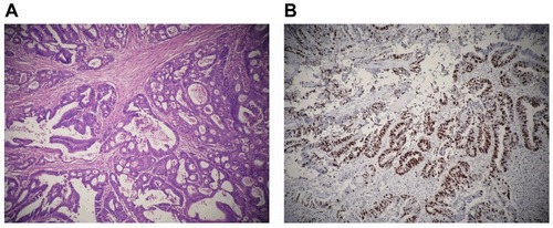 Figure 2 Microscopic findings of the rectum mass. (A) Results showed tubular adenocarcinoma (H-E, original magnification, ×100). (B) The immunoenzyme labeled Ki-67 test showed 55% of the tumor tissue was positive (IH, original magnification, ×100).