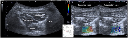 Figure 3. Ultrasound imaging for thickness (A) and stiffness (B) measurements of the temporalis muscle. White dashed line, maximal muscle thickness; LPM, lateral pterygoid muscle; CORP, coronoid process of the mandible.
