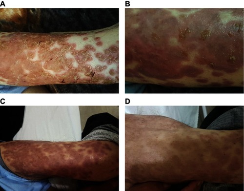 Figure 3 (A) The patchy and vesicular plaque lesions with dermatomal pattern on anterior left thigh at first day of admission and treatment. (B) Skin lesions after 1 month of treatment. (C) Healed skin lesions at 2 months after treatment. (D) Vanished papulovesicular lesions and eftfading pigmented macula and patches at the end of third month after treatment.