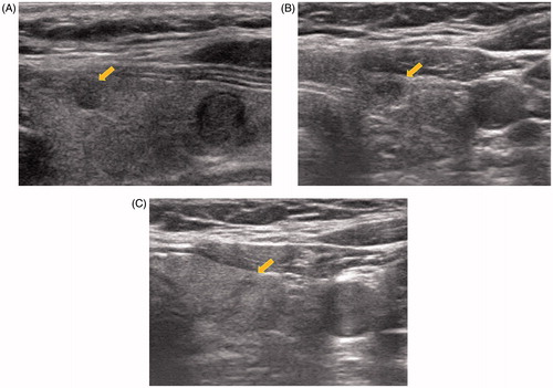 Figure 3. Gradual reduction and complete disappearance of papillary thyroid microcarcinoma after one session of radiofrequency ablation. (A) Initial US of a 49-year-old woman revealed a 0.8 cm mass in the left thyroid gland proven as papillary thyroid carcinoma on CNB. (B) At one-year follow-up after one session of RFA, US revealed a smaller, 0.4-cm ill-defined ablation zone in the left thyroid gland. (C) At 24-months follow-up after RFA, US revealed complete disappearance of ablation zone with subtle scar in the left thyroid.
