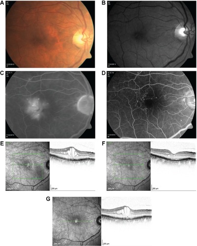 Figure 3 A 72-year-old patient with diabetic macular edema in the right eye previously treated with three monthly injections of intravitreal bevacizumab.