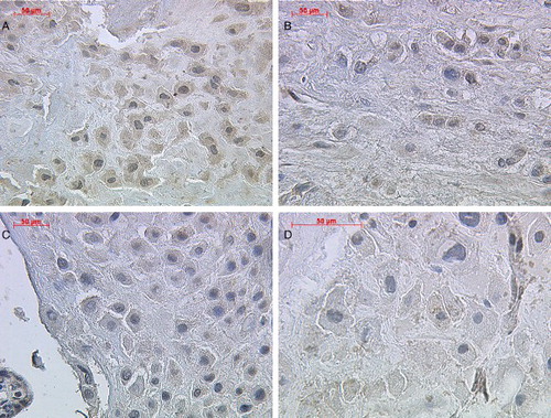 Figure 2. Immunohistochemical staining reaction of inhibin-βC in placental extravillous trophoblast cells. Extravillous trophoblast cells demonstrated a positive cytoplasmatic staining intensity for inhibin-βC antibody in normal (A; lens 20, upper left panel), preeclamptic (B; lens 20, upper right panel), HELLP (C; lens 20, lower left panel), and IUGR (D; lens 40, lower right panel) placental tissue.