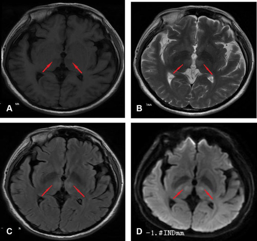 Figure 1 (A) Magnetic resonance T1-weighted imaging. Images show abnormal low signal bilateral paramedian thalamic lesions (arrows). (B) Magnetic resonance T2-weighted imaging. Images show abnormal hyperintense bilateral paramedian thalamic lesions (arrows). (C) Fluid attenuated inversion recovery echo MRI. Images show abnormal hyperintense bilateral paramedian thalamic lesions (arrows). (D) Diffusion-weighted axial MR showing diffusion restriction of the bilateral paramedian thalamus (arrows).