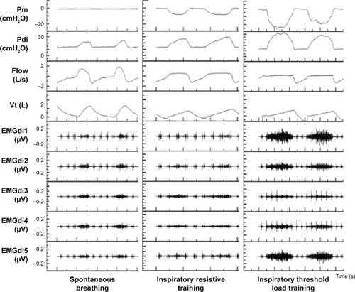 Figure 4 The waveforms of mouth pressure, diaphragmatic pressure, respiratory flow rate, tidal volume, and EMGdi of COPD patients during spontaneous breathing, respiratory resistance, and threshold load training.