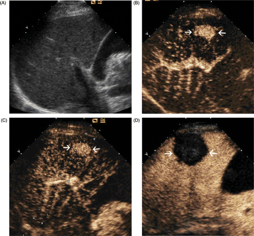 Figure 1. Images in a 64-year-old man who underwent CEUS guidance MW ablation of HCC in segment V of the liver. (A) Conventional US could not detect the tumour. (B) The CEUS arterial phase image shows a 2.2 × 1.4 cm tumour in the right hepatic lobe (arrows). (C) MW antenna was inserted along the guideline under CEUS guidance (arrows). (D) Arterial phase of CEUS obtained 3 months after MW ablation shows complete necrosis of the tumour (arrows).