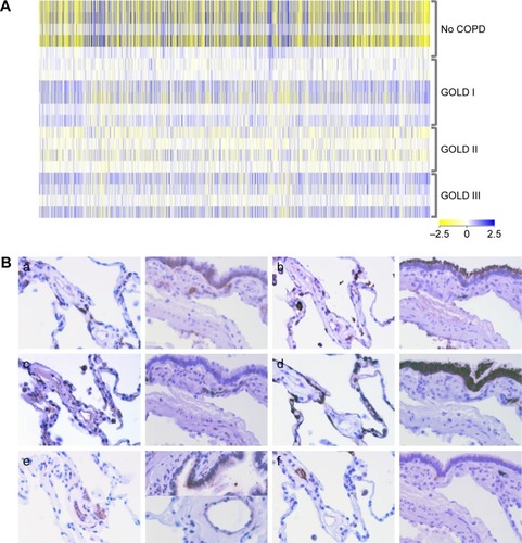 Figure 1 Transcriptome analyses and selected protein candidates in tissue microarrays.