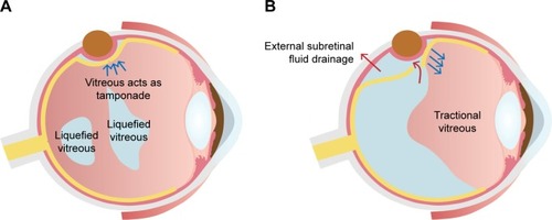 Figure 4 Different effects of SB according to the vitreous status.