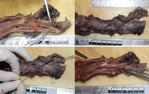 Figure 1. (A) A 2.5-cm longitudinal intimal tear (red arrow) was found in the right common iliac artery (RCI). (B) The thrombosed false lumen involved the abdominal aorta (AA) proximally and the left common iliac artery (LCI), forming a bulging appearance. (C) The 0.7-cm adventitial rupture of the abdominal aortic (AA) dissection (red arrow), 2.5 cm above the aortic bifurcation. The probes indicate communication between the adventitial rupture of the abdominal aorta (AA), dissection of the left common iliac artery (LCI) and the intimal tear of the right common iliac artery (RCI). (D) The luminal view, with the probes showing the communication.