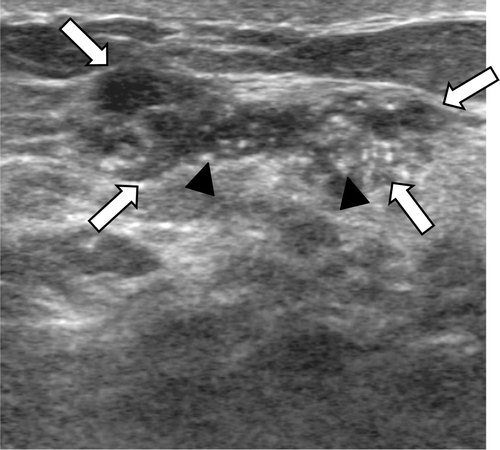 Figure 1.  A 37-year-old female with a grade 3 invasive ductal carcinoma. An ultrasound image demonstrates an irregular shaped, not circumscribed marginated, isoechoic mass (arrows) with an abrupt boundary and internal calcifications (arrowheads). On a histological examination, the cancer was ER and PR positive and HER-2/neu positive.