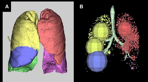 Figure 2 (A) 3-D analysis by SYNAPSE shows the lung lobes with a different color: yellow, right upper lobe; blue, right middle lobe; green, right lower lobe; red, left upper lobe; purple, left lower lobe. (B) 3-D analysis by the SYNAPSE shows the emphysematous area. The larger the area, the more severe the emphysema.