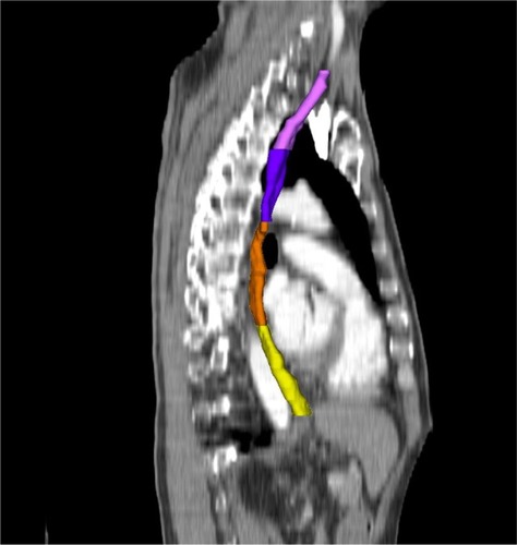 Figure 1 Sagittal section illustrating delineation of the cervical esophagus (pink), the upper thoracic esophagus (purple), the mid-thoracic esophagus (orange), and the lower thoracic esophagus (yellow).
