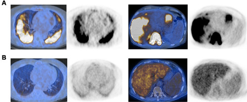 Figure 3 Examples of fusion PET/CT of organs with biopsy-proven IVLBCL involvement. (A) Axial fusion PET/CT and PET images of a Nodal group patient with bilateral focal consolidative lung involvement (left) and an EN/DS5 group patient with focal liver and bone marrow involvement (right) showing intense FDG uptake (DS 5). (B) Axial fusion PET/CT and PET images of an EN/DS3-4 group patient with lung involvement showing bilateral diffuse GGOs with mild FDG uptake (left; DS 3) and another patient with liver involvement showing diffuse moderate FDG uptake (right; DS 4).