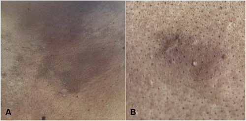 Figure 4 Sites of the lesions after completing 12 sessions of electron beam radiotherapy showing post-inflammatory hyperpigmented patches and scars of previous skin punch biopsies. (A) Lesion on the upper left chest. (B) Lesion on the upper left back.