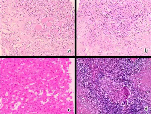 Figure 2 Pathological findings:((a) supraclavicular lymph node biopsy; (b) pleural biopsy) granulomatous inflammation; (c) (liver biopsy) necrotizing granulomatous inflammation (acid-fast bacilli staining was positive); (d) cervical lymph node excisional biopsy: necrotizing granulomatous inflammation, consistent with TB (HES staining ((a) ×200. (b) ×200. (c) ×200. (d) ×100)).