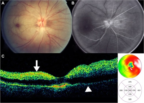 Figure 43 Central retinal artery occlusion.