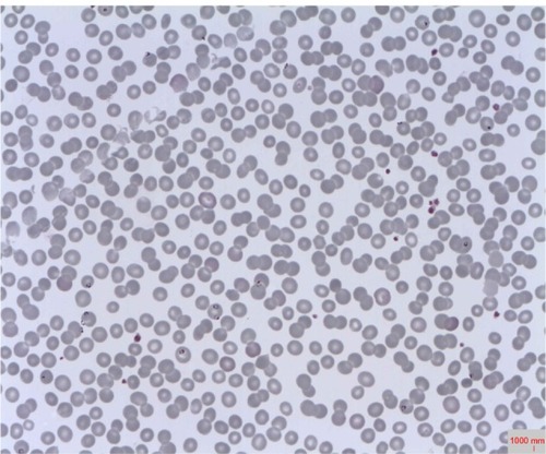 Figure 1 A Plasmodium falciparum-positive slide.