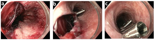 Figure 2. (a–c) Endoscopic images of esophageal perforation in case III. The defect was located just above the esophagogastric junction (a) and was successfully closed with 15 endoclips (b and c).