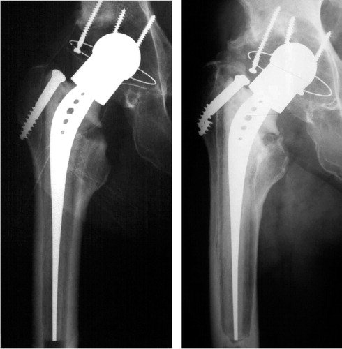 Figure 2 Isoelastic prosthesis, showing (a) close contact between the implant and bone, and (b) massive osteolysis along the whole length of the prosthesis after 9.7 years in situ.