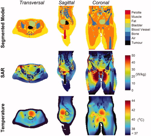 Figure 5. Patient model, SAR and Temperature maps. Transverse, sagittal and coronal cross-sections of the segmented model (first row), showing all the tissues included in the patient model, the SAR distribution (second row) and the temperature distribution (third row) in the patient. The GTV contour is indicated in black.