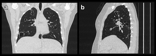 Figure 2. Coronal (a), sagittal (b) high resolution computed tomography images showing conglomerates of cystic bronchiectasis in upper lobes and thick-walled and heterogeneous sized cysts in lower lobes. In Figure 2(b) the cystic conglomerates are seen in conjunction with an accompanying and bronchiole with bronchial wall thickening