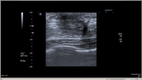 Figure 1 A hypoechoic solid mass with ill-defined border with no microcalcification.