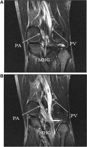 Figure 2 (A) The left knee coronal T2 with contrast MRI, (B) the popliteal artery compressed by the medial head of the gastrocnemius muscle to thicken the vessel wall.Abbreviations: PA, popliteal artery; PV, popliteal vein; MHG, medial head of gastrocnemius muscle.