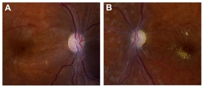 Figure 4 Color photographs of the right (A) and left (B) eyes 5 months after pan-retinal photocoagulation, demonstrating regression of neovascularization of the disk. Optic atrophy and pallor are present.