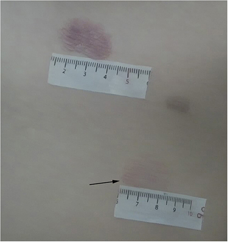 Figure 10 2 months after termination of treatment, the lesions had almost disappeared, with only residual skin erythema remaining. The black arrow indicates the observation area for the dermoscope.