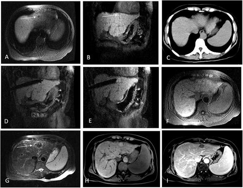 Figure 2. Recurrent HCC in the hepatic dome abutting to heart of a 55-year-old woman treated with MR-guided RFA. (A,B) The recurrent nodule in segment IV (arrow), 3 mm from pericardium, is 7 mm in diameter and appears hypointense in T1WI before RFA. (C) The recurrent nodule is displayed unclearly on plain CT scan. (D) The RF electrode is targeted gradually using the tilting of the puncture path under the coronal 3D-T1WI guidance. When the RF electrode reaches the edge of the nodule, the inner expandable multitined electrodes are expanded to 2.0 cm to overlap the nodule without penetrating the diaphragm. (E–G) After RFA, the nodule is completely overlapped by the rim of the hyperintensity on 3D-T1WI and hypointensity on T2WI (arrow in G). (H,I) The lesion is completely ablated without diaphragm and heart injury at 4-month follow-up by enhanced MRI.