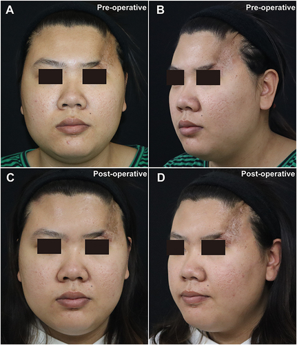 Figure 1 Facial photography of the patient. (A) Pre-operative front photo, (B) Pre-operative left 45-degree photo, (C) Post-operative front photo, (D) Post-operative left 45-degree photo.