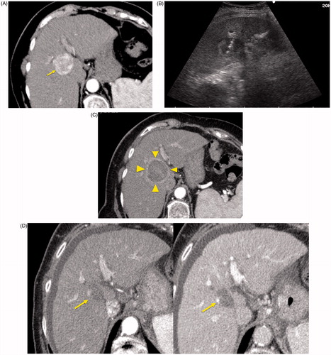 Figure 1. An 84-year-old woman with a history of cirrhosis and hepatitis C. (A) Contrast-enhanced computed tomography (CECT) image demonstrates an arterial-enhanced lesion in segment IV measuring 4.0 cm (arrow). (B) Lesion was treated with the placement of a single cooled microwave antenna at 40 W for 15 min. (C) A 24-h post-procedural CECT demonstrates the presence of a thick hypervascular peri-ablation halo (triangles). This finding can be seen from the hyperemic reaction that regularly develops around an ablation zone. (D) Four-year follow-up of an arterial-phase (left) and portal-venous phase (right) CECT demonstrates contraction of the ablation zone (arrow) with no evidence of enhancement.