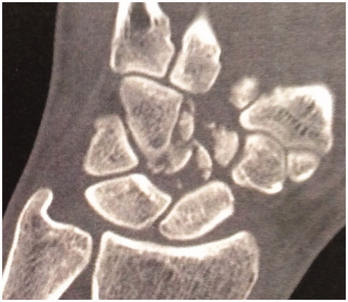 Figure 3. Pre-operative CT-scan case 2.