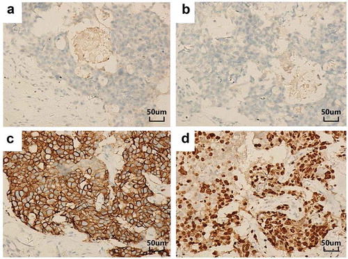 Figure 1. IHC results of the primary right breast carcinoma (original magnification, 200×). The tumor stained negative for both ER (a) and PR (b) but strongly positive for HER-2 (c) and showed a Ki-67 proliferation index of 50–75% (d).