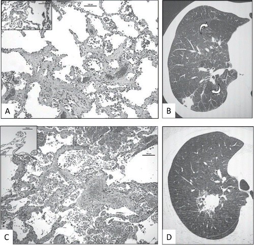 Figure 3. Examples of radiologic–pathologic correlation in prospective lung cancer cohort subjects with heavy burden of SRIF. A. Right upper lobectomy of subject X with histological evidence of SRIF (insert shows normal lung away from SRIF and cancer). Scale as indicated. B. Corresponding magnified view of high resolution CT thorax of right upper lobe, showing centrilobular emphysema (arrows) and no visible interstitial lung abnormality. C. Right upper lobectomy sample of subject Y with histological evidence of SRIF (insert shows normal lung away from SRIF and cancer). Scale as indicated. D. Corresponding magnified view of high resolution CT thorax of right upper lobe, showing tumour, emphysema and no discernible interstitial lung abnormality.