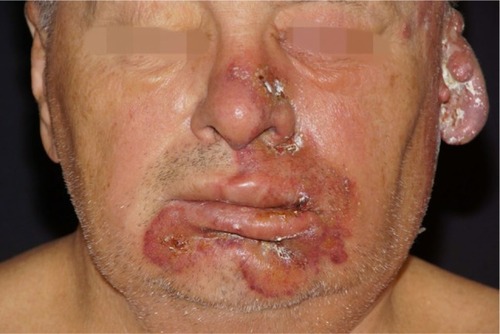 Figure 2 Perioral bullous impetigo, herpetiform vesicles on the nose.