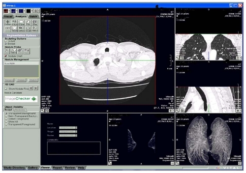 Figure 1 CAD software. In the left-hand corner are various operational tools while in the center, the main window shows the lung under study. In the right-hand corner multiplanar views of the lung can be seen.