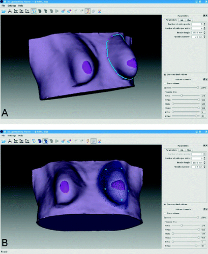 Figure 2. Workflow of the lipomodeling planning software. (A) Contouring of the breast. (B) Region selection (blue mesh) and syringe entry points selection (cyan points). (C) Planned fatty tissue deposition direction on the ROI mesh (visualized as a wireframe).