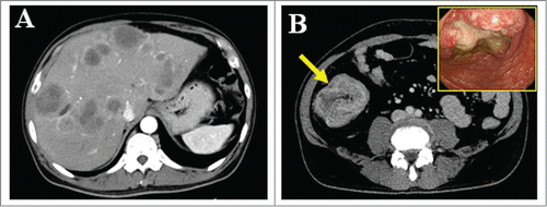 Figure 1. Radiological findings of this case. (A) Abdominal computed tomography revealed multiple metastatic tumors in the liver and (B) thickening of the ascending colonic wall. (B, inset) Total colonoscopy demonstrated a large ulcerated and circumferential tumor at the same region.