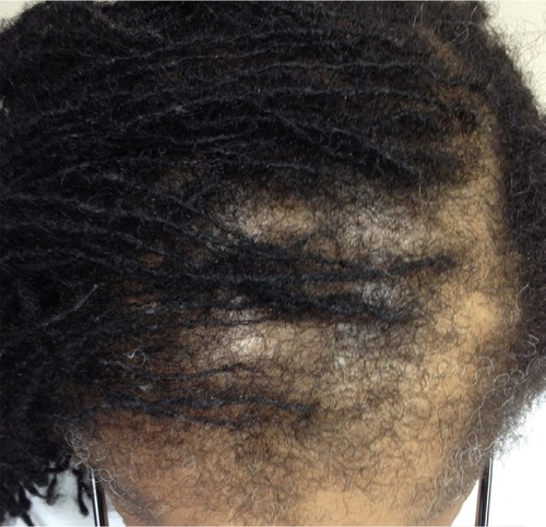 Figure 2 Biopsy-proven traction alopecia involving the frontal and parietal scalp.